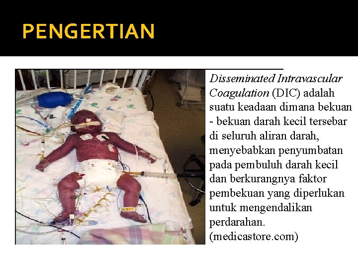 PENGERTIAN Disseminated Intravascular Coagulation (DIC) adalah suatu keadaan dimana bekuan - bekuan darah kecil