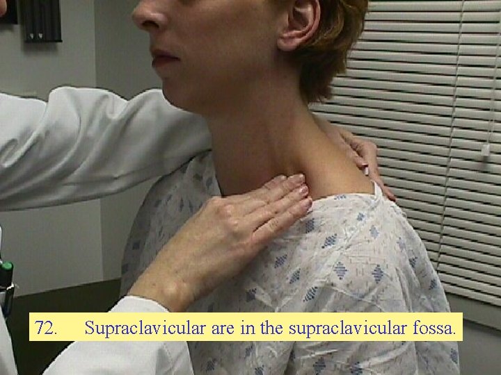 72. Supraclavicular are in the supraclavicular fossa. 