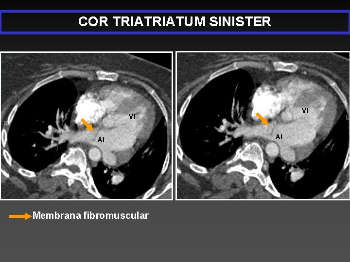COR TRIATUM SINISTER VI VI AI Membrana fibromuscular AI 