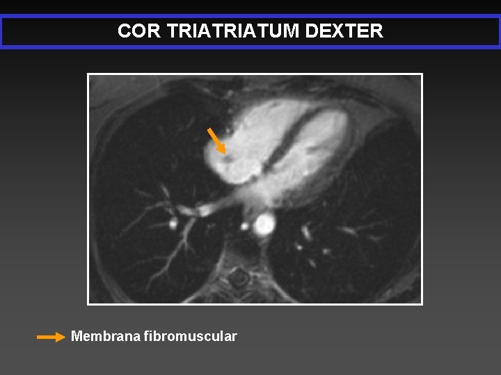 COR TRIATUM DEXTER Membrana fibromuscular 