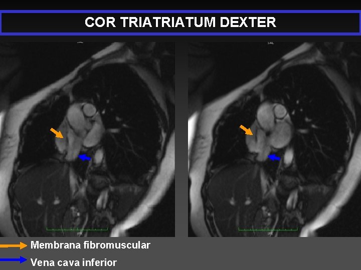 COR TRIATUM DEXTER Membrana fibromuscular Vena cava inferior 