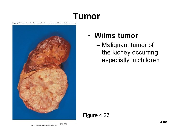 Tumor • Wilms tumor – Malignant tumor of the kidney occurring especially in children