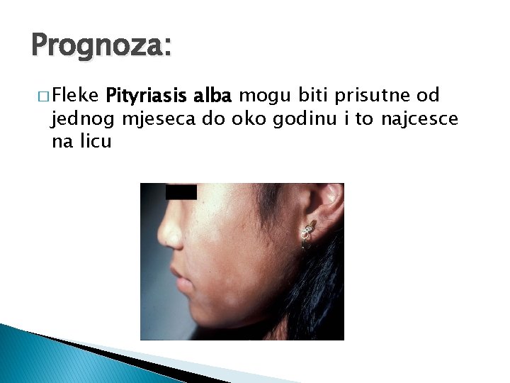 Prognoza: � Fleke Pityriasis alba mogu biti prisutne od jednog mjeseca do oko godinu