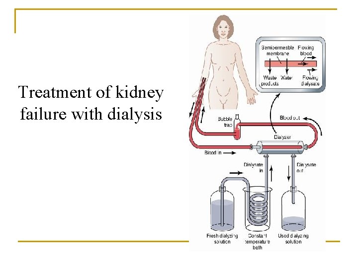 Treatment of kidney failure with dialysis Treatment of kidney failure with dialysis