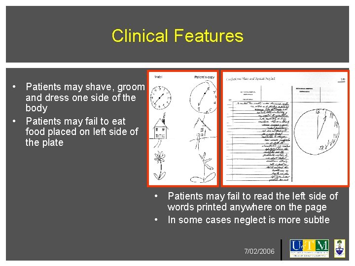 Clinical Features • Patients may shave, groom and dress one side of the body Clinical Features • Patients may shave, groom and dress one side of the body