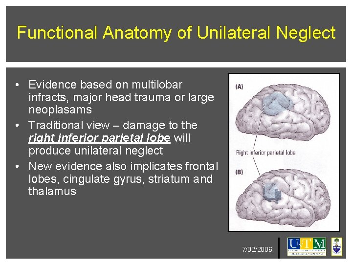Functional Anatomy of Unilateral Neglect • Evidence based on multilobar infracts, major head trauma