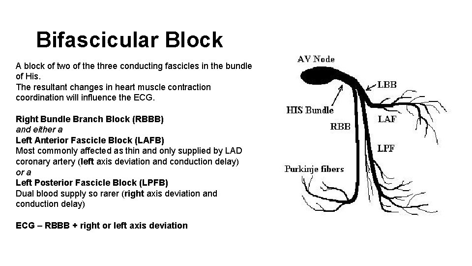Bifascicular Block A block of two of the three conducting fascicles in the bundle