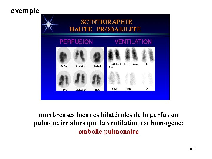 exemple nombreuses lacunes bilatérales de la perfusion pulmonaire alors que la ventilation est homogène: exemple nombreuses lacunes bilatérales de la perfusion pulmonaire alors que la ventilation est homogène: