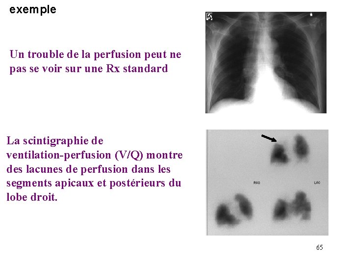 exemple Un trouble de la perfusion peut ne pas se voir sur une Rx exemple Un trouble de la perfusion peut ne pas se voir sur une Rx