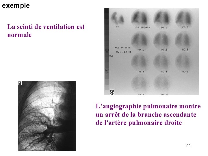 exemple La scinti de ventilation est normale L’angiographie pulmonaire montre un arrêt de la exemple La scinti de ventilation est normale L’angiographie pulmonaire montre un arrêt de la