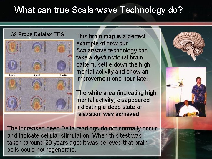 What can true Scalarwave Technology do? 32 Probe Datalex EEG This brain map is