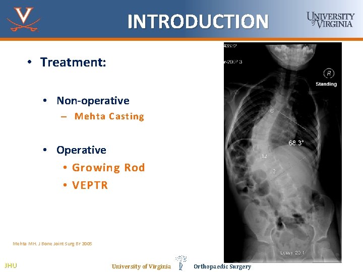 INTRODUCTION • Treatment: • Non-operative – Mehta Casting • Operative • Growing Rod •