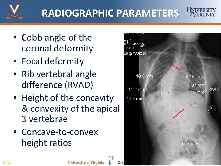 RADIOGRAPHIC PARAMETERS • Cobb angle of the coronal deformity • Focal deformity • Rib