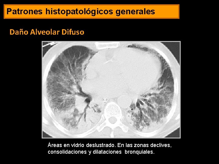 Patrones histopatológicos generales Daño Alveolar Difuso Áreas en vidrio deslustrado. En las zonas declives,