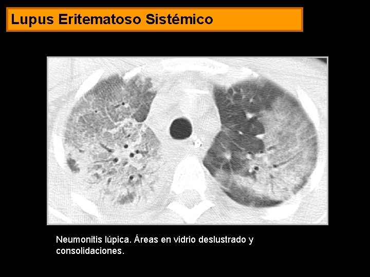 Lupus Eritematoso Sistémico Neumonitis lúpica. Áreas en vidrio deslustrado y consolidaciones. 