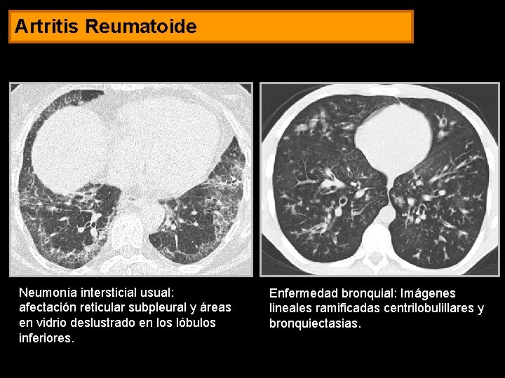 Artritis Reumatoide Neumonía intersticial usual: afectación reticular subpleural y áreas en vidrio deslustrado en