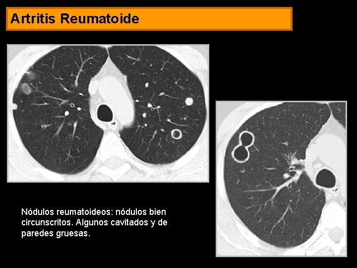 Artritis Reumatoide Nódulos reumatoideos: nódulos bien circunscritos. Algunos cavitados y de paredes gruesas. 