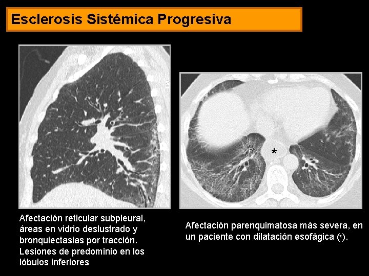 Esclerosis Sistémica Progresiva * Afectación reticular subpleural, áreas en vidrio deslustrado y bronquiectasias por