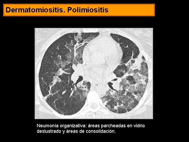 Dermatomiositis. Polimiositis Neumonía organizativa: áreas parcheadas en vidrio deslustrado y áreas de consolidación. 
