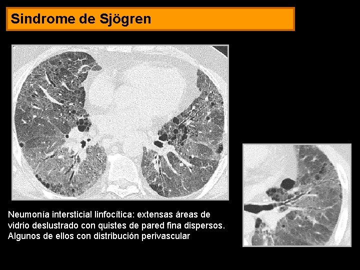 Sindrome de Sjögren Neumonía intersticial linfocítica: extensas áreas de vidrio deslustrado con quistes de