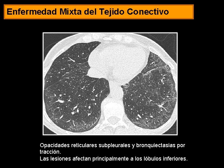 Enfermedad Mixta del Tejido Conectivo Opacidades reticulares subpleurales y bronquiectasias por tracción. Las lesiones