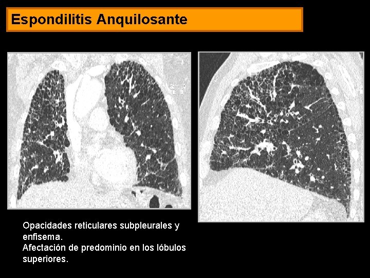 Espondilitis Anquilosante Opacidades reticulares subpleurales y enfisema. Afectación de predominio en los lóbulos superiores.