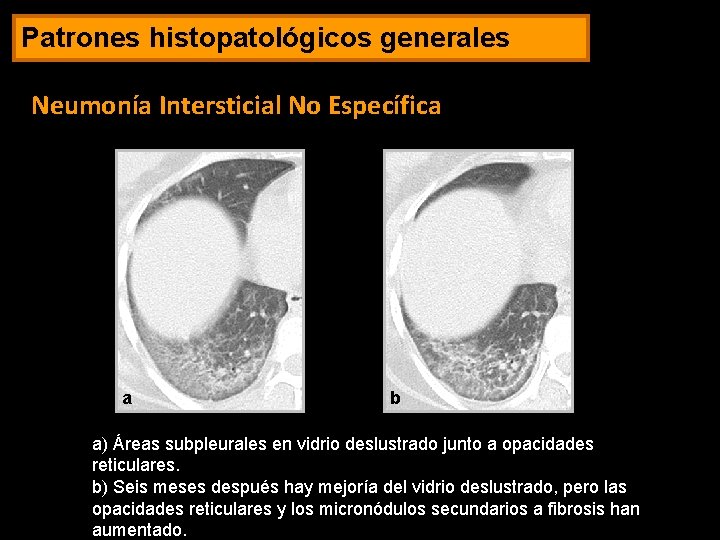 Patrones histopatológicos generales Neumonía Intersticial No Específica a b a) Áreas subpleurales en vidrio