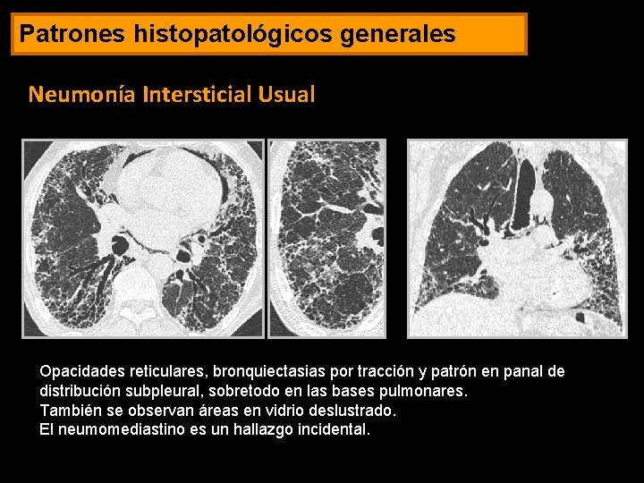 Patrones histopatológicos generales Neumonía Intersticial Usual Opacidades reticulares, bronquiectasias por tracción y patrón en