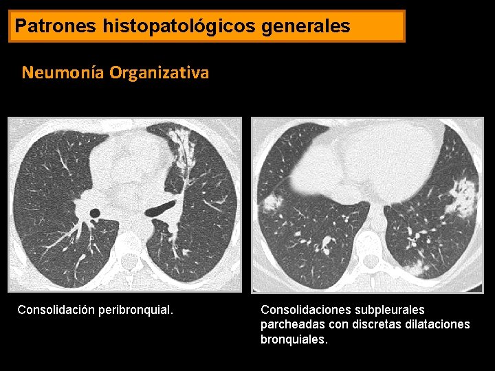 Patrones histopatológicos generales Neumonía Organizativa Consolidación peribronquial. Consolidaciones subpleurales parcheadas con discretas dilataciones bronquiales.