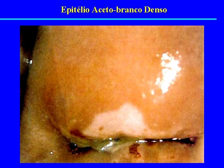 Epitélio Aceto-branco Denso 