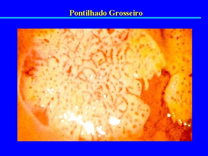 Pontilhado Grosseiro 