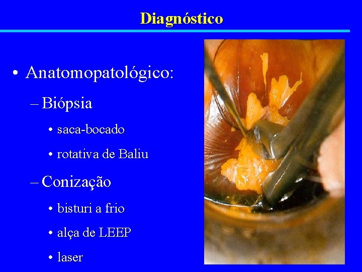 Diagnóstico • Anatomopatológico: – Biópsia • saca-bocado • rotativa de Baliu – Conização •