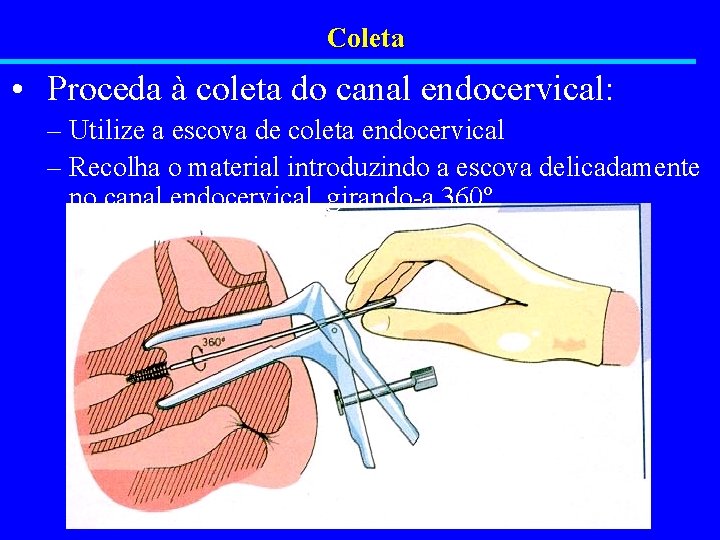 Coleta • Proceda à coleta do canal endocervical: – Utilize a escova de coleta