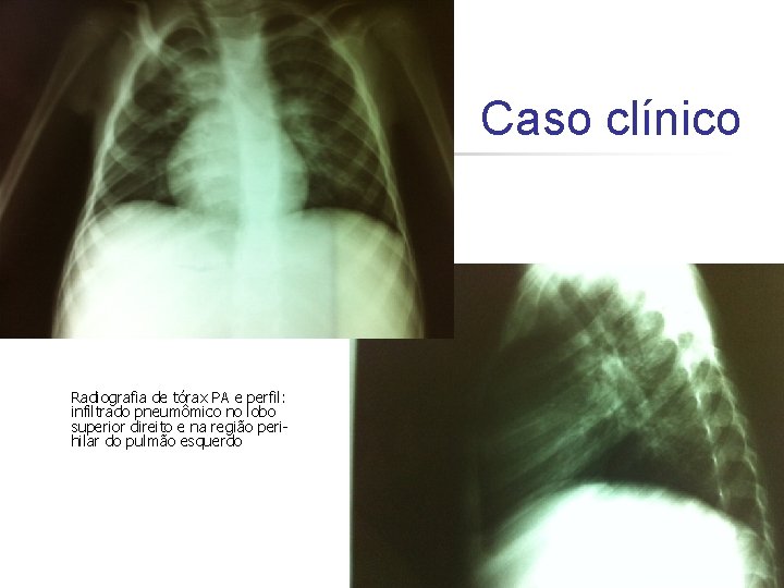 Caso clínico Radiografia de tórax PA e perfil: infiltrado pneumômico no lobo superior direito Caso clínico Radiografia de tórax PA e perfil: infiltrado pneumômico no lobo superior direito