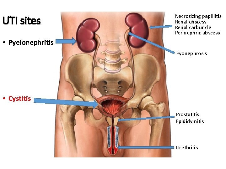 UTI sites Necrotizing papillitis Renal abscess Renal carbuncle Perinephric abscess • Pyelonephritis Pyonephrosis •