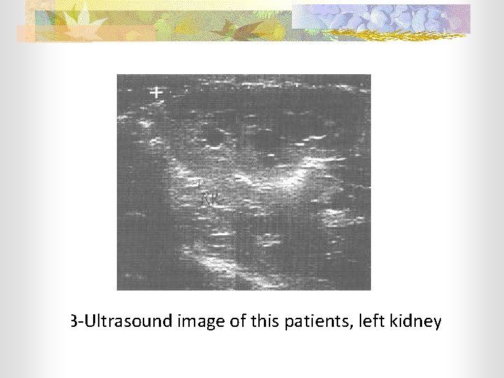  • B-Ultrasound image of this patients, left kidney 