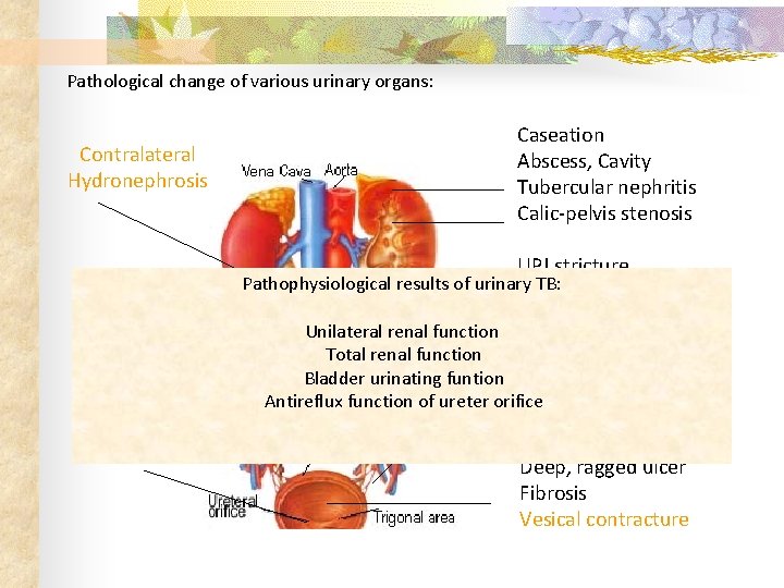 Pathological change of various urinary organs: Contralateral Hydronephrosis Caseation Abscess, Cavity Tubercular nephritis Calic-pelvis