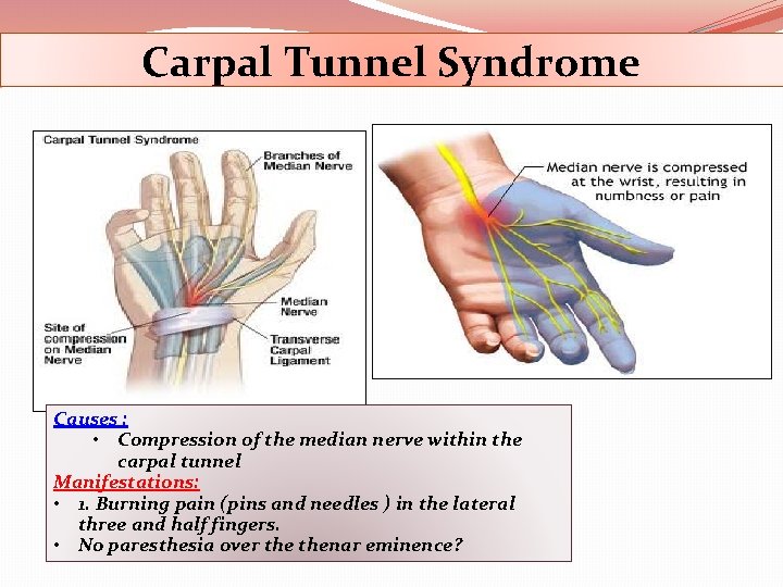 Carpal Tunnel Syndrome Causes : • Compression of the median nerve within the carpal