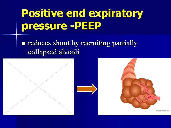 Positive end expiratory pressure -PEEP n reduces shunt by recruiting partially collapsed alveoli 