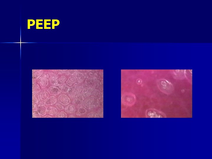 PEEP 