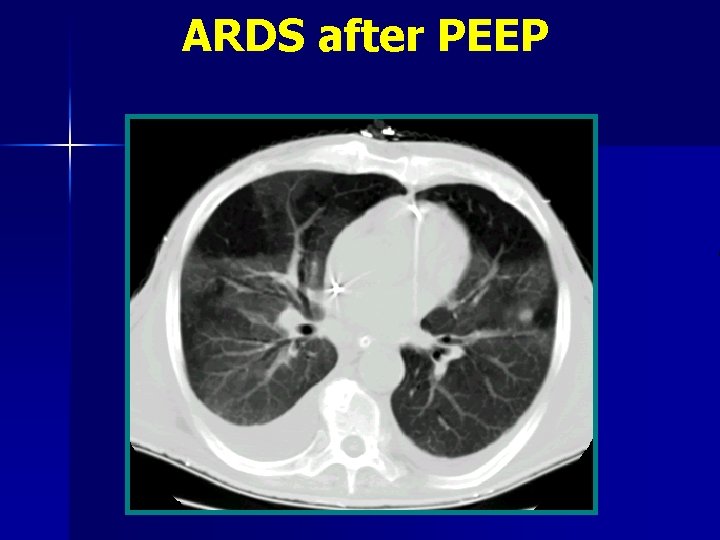 ARDS after PEEP 