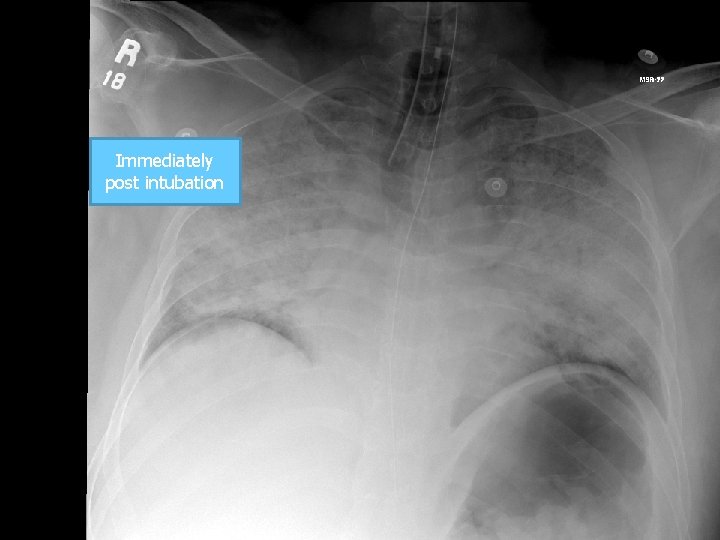 Immediately post intubation 