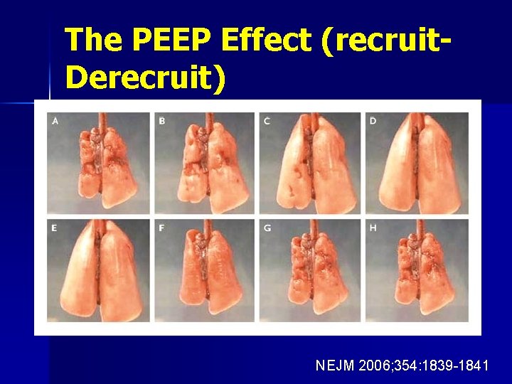 The PEEP Effect (recruit. Derecruit) NEJM 2006; 354: 1839 -1841 