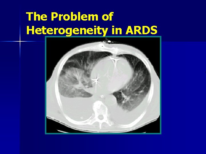 The Problem of Heterogeneity in ARDS -10 0 10 