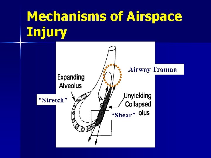 Mechanisms of Airspace Injury Airway Trauma “Stretch” “Shear” 