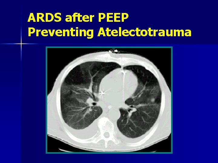 ARDS after PEEP Preventing Atelectotrauma 