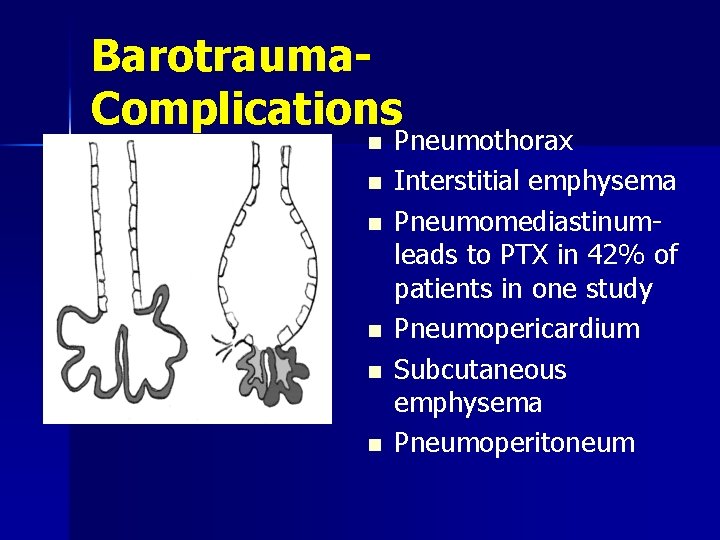 Barotrauma. Complications n n n Pneumothorax Interstitial emphysema Pneumomediastinumleads to PTX in 42% of