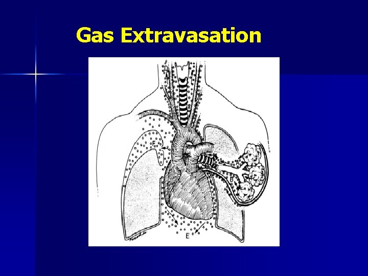 Gas Extravasation 