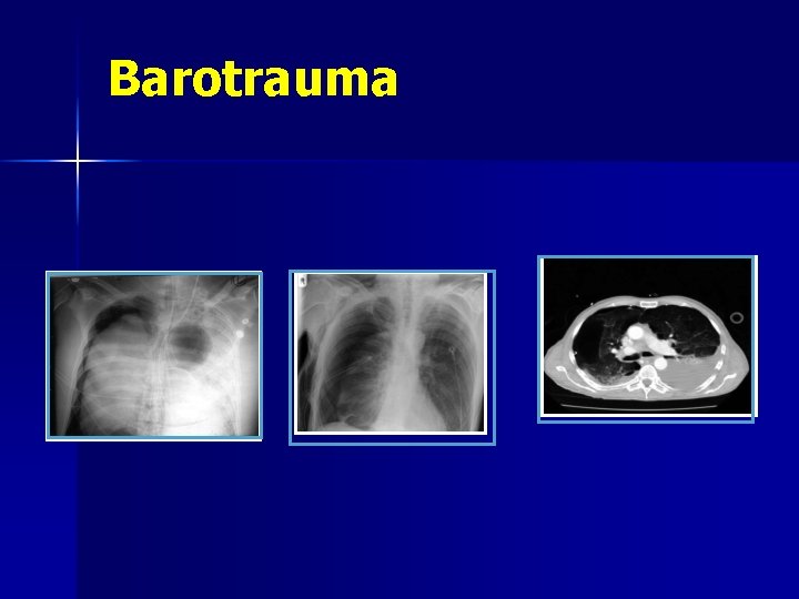 Barotrauma 