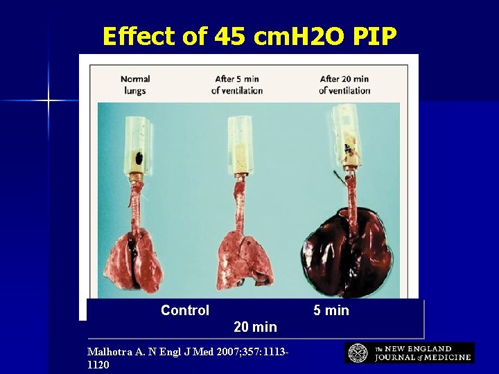Effect of 45 cm. H 2 O PIP Control 5 min 20 min Malhotra